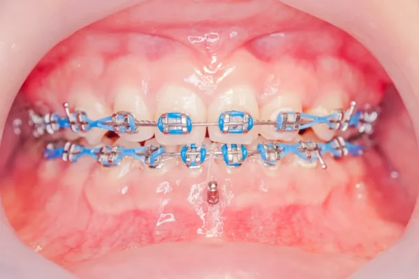 Orthodontic Mini Implants