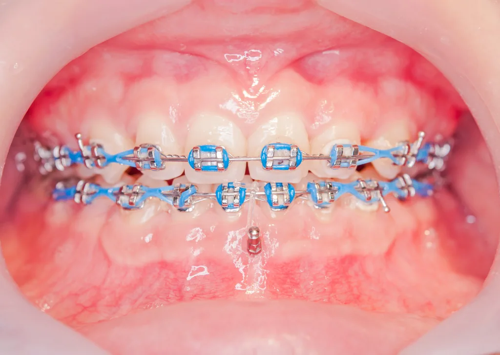 Orthodontic Mini Implants: What to Know? - CK Health Turkey