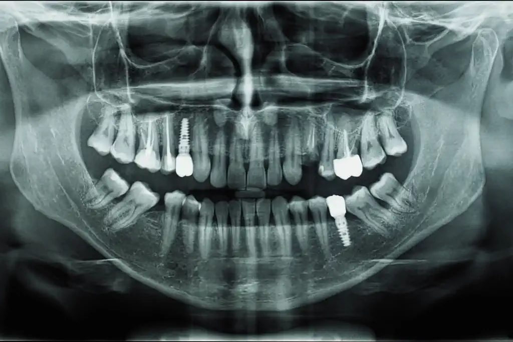 Dental Implants In Turkey