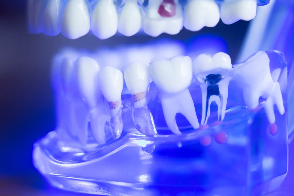 Root Canal Treatment In Turkey