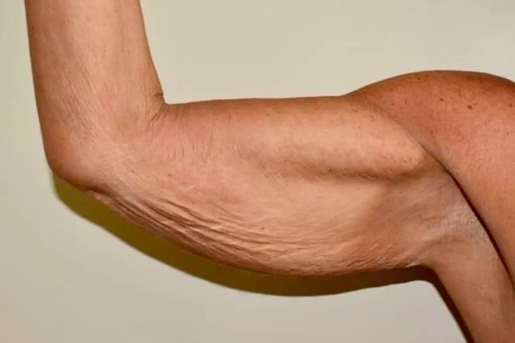 Arm Liposuction Turkey: Everything You Need to Know