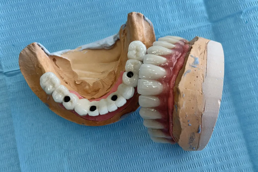 Full Mouth Dental Implants in Turkey: Cost, Benefits and Process