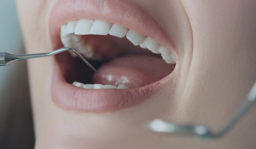 Dental Fillings: What to Expect