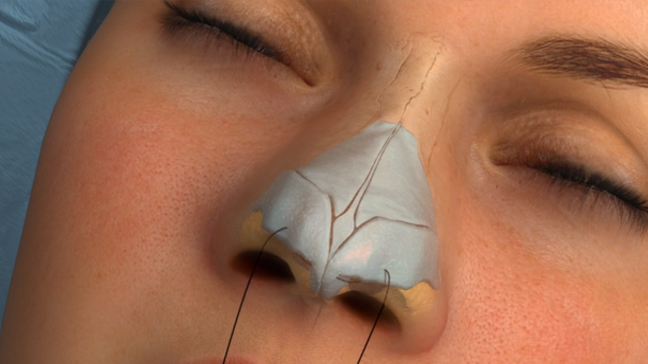 Nose Surgery for Breathing: Enhancing Function and Confidence