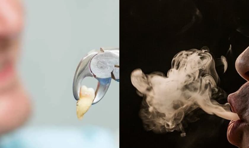 The Dangers of Smoking After Tooth Extraction: How to Protect your Oral Health