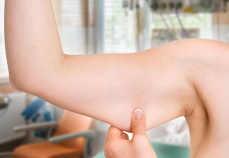 Arm Lift Scars After 1 Year: What to Expect and How to Minimize Scarring