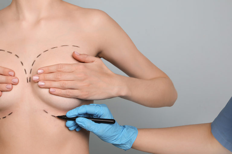 Breast Lift Without Implants: Exploring Natural Mastopexy Options