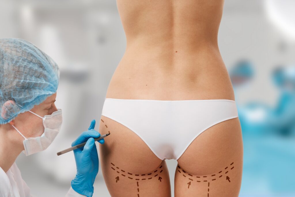 Fat Transfer to Buttocks: What You Need to Know About the Procedure