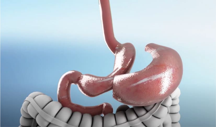 Gastric Sleeve Revision