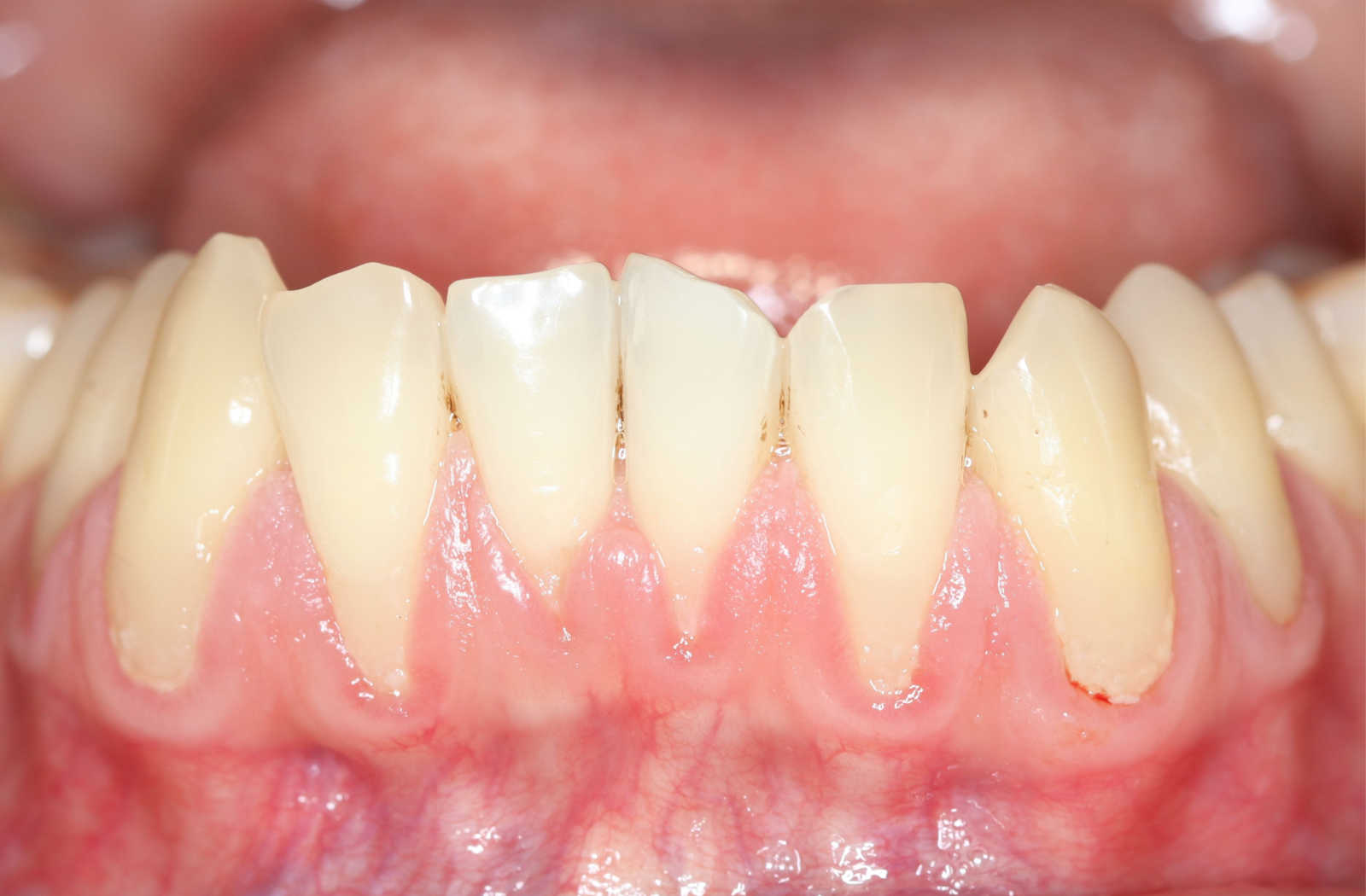 Gum Graft Before and After – What to Expect