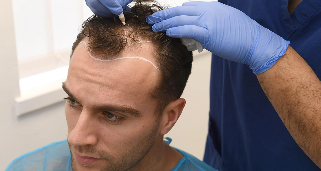 Hair Transplant Care: Guidelines and Tips for Optimal Results