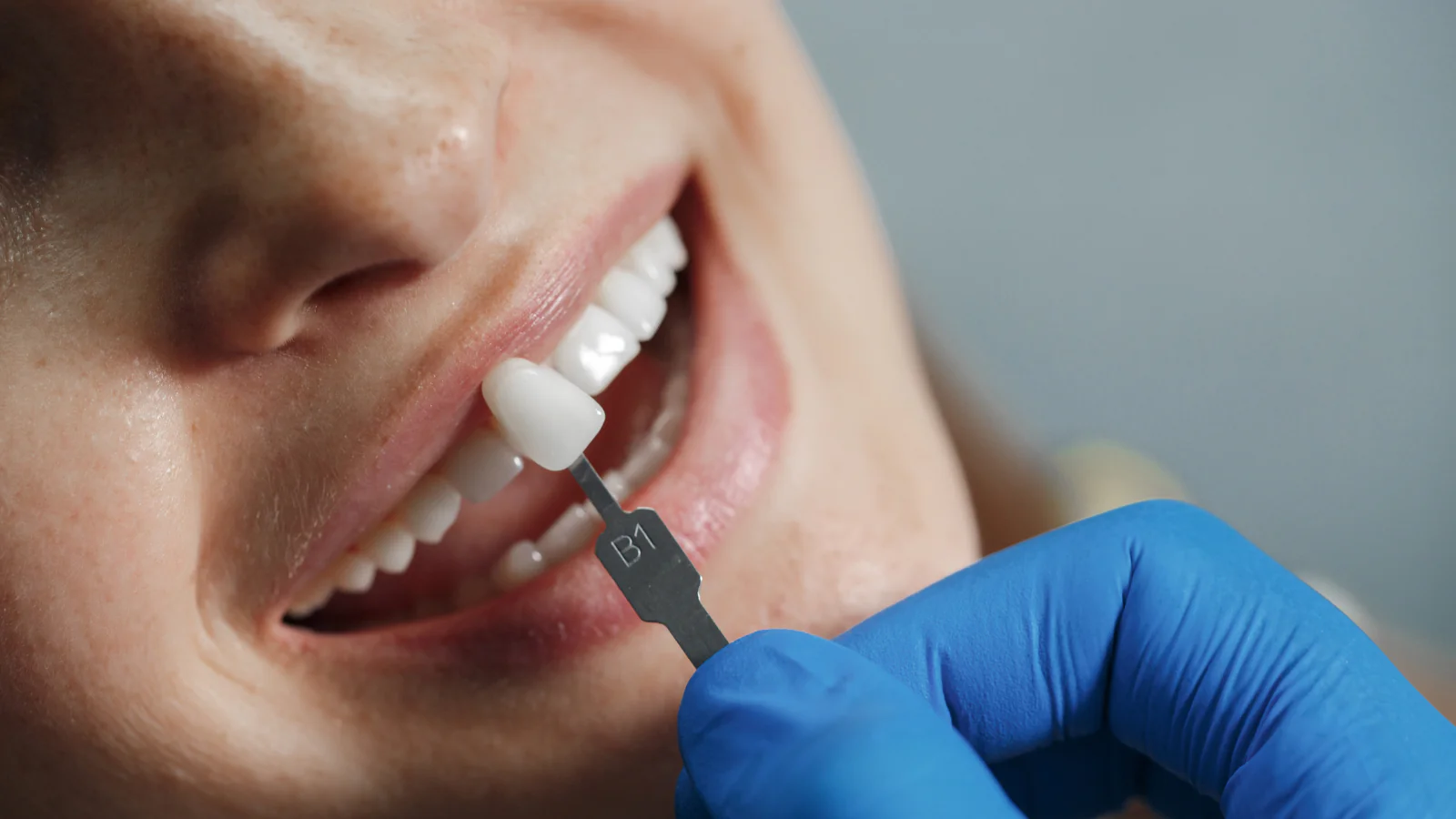 How Long Do Veneers Last? A Comprehensive Guide to a Radiant Smile