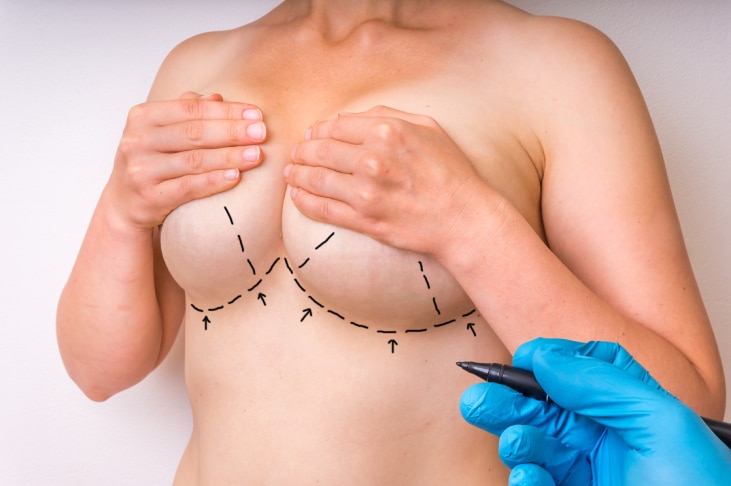 Lollipop Breast Lift Without Implants: A Gentle, Natural Approach to Feeling Like Yourself Again