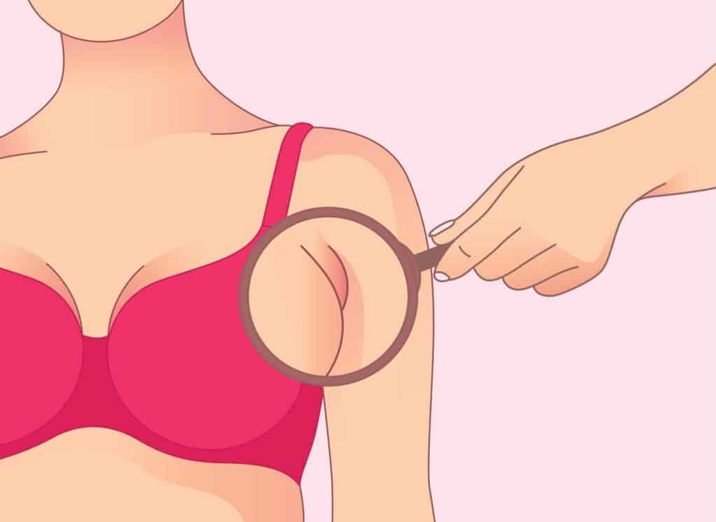 Underarm Liposuction: Targeting the Bra Bulge with Precision and Confidence