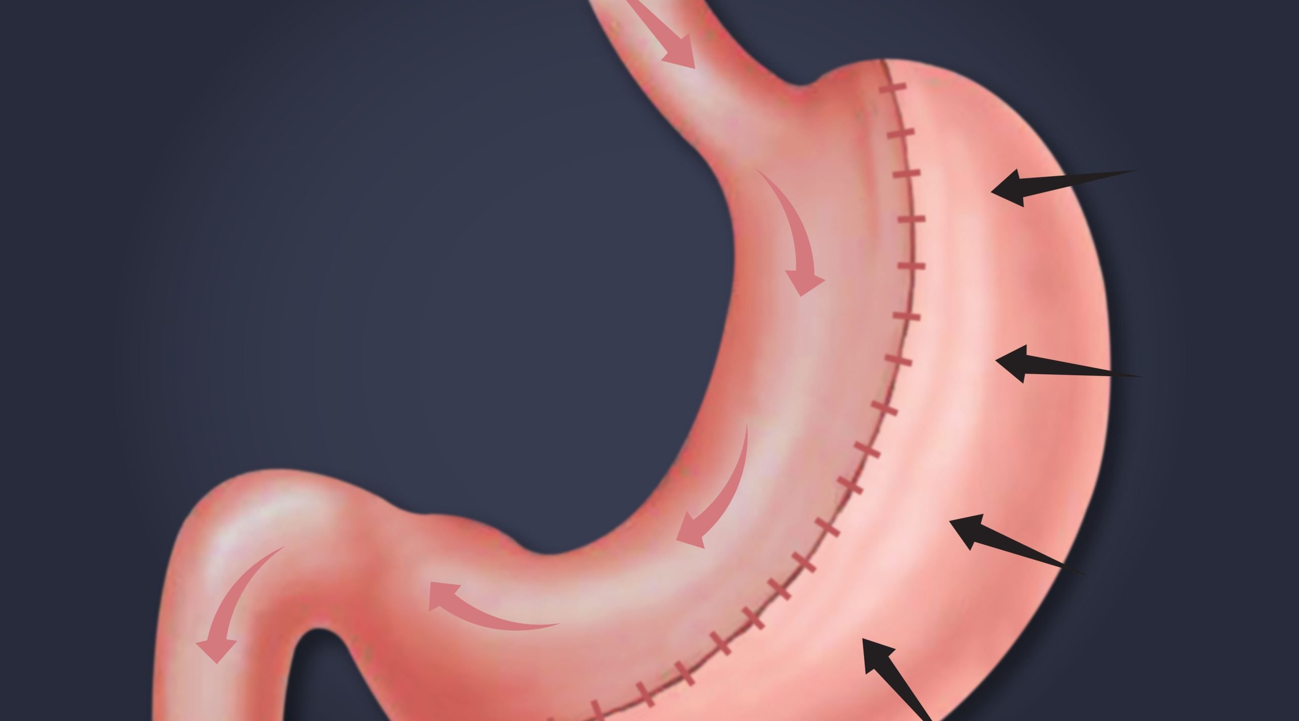 Understanding Gastric Sleeve Complications: What Matters Most Is How We Prevent Them