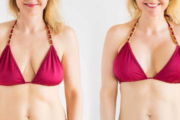 Breast Tightening Treatment