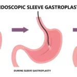 Endoscopic Sleeve Gastroplasty
