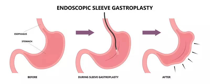 Endoscopic Sleeve Gastroplasty