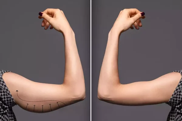 Arm Lift Surgery