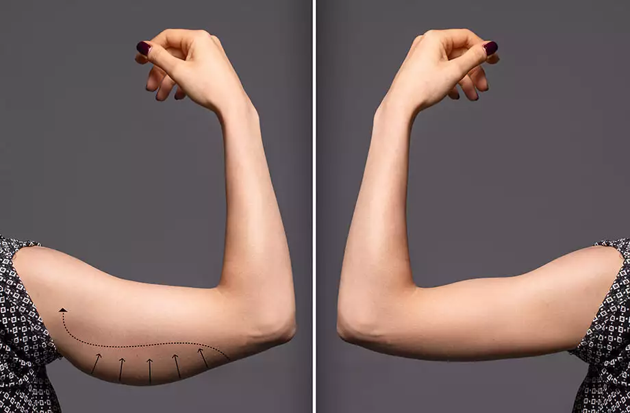 Arm Lift Surgery