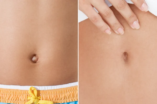 Belly Button Plastic Surgery