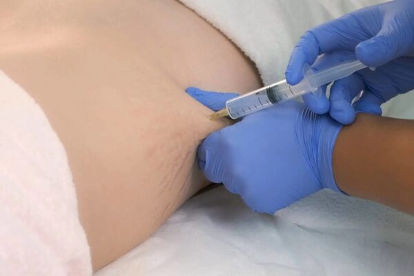 Autologous Fat Injection