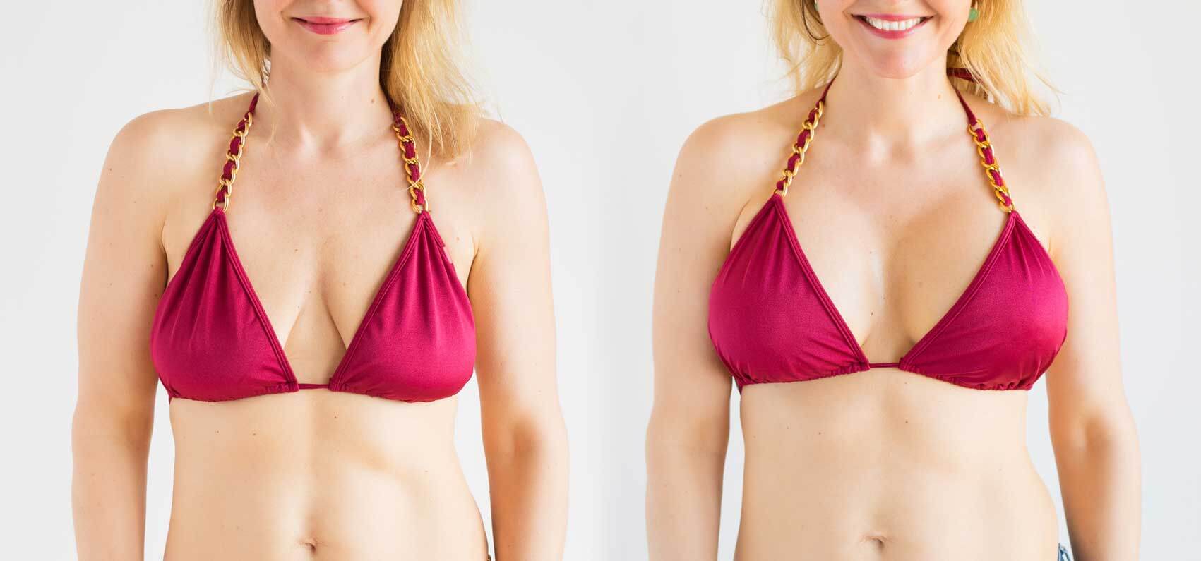 Breast Lift & Tightening: Non-Surgical & Medical Options