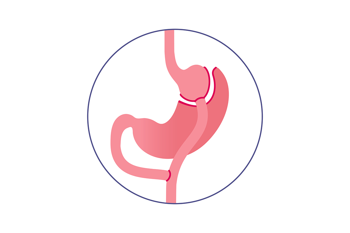 Mini Gastric Bypass Surgery