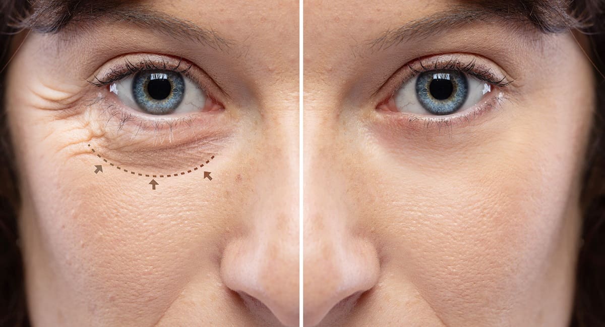 Blepharoplasty