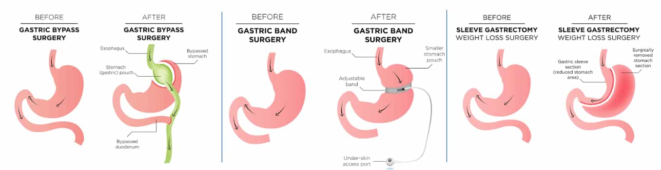 Weight Loss Surgery: Before & After Photos, Gender-Specific Results, and Recovery Process