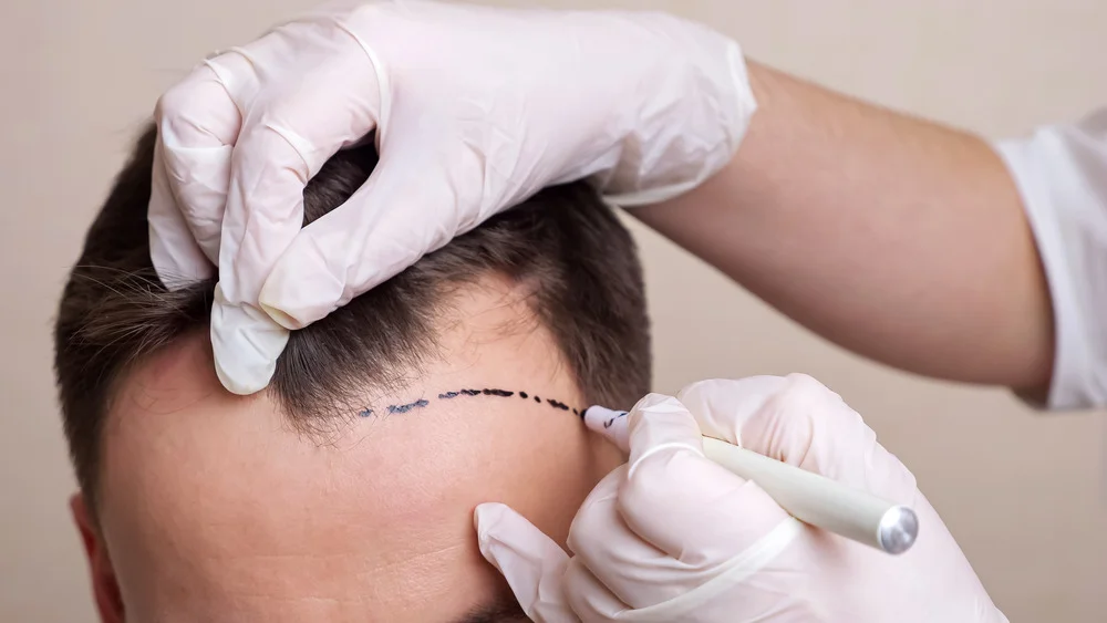 3000 Grafts Hair Transplant Coverage, Costs and Techniques