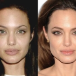 Angeline Jolie Neck and Facelift