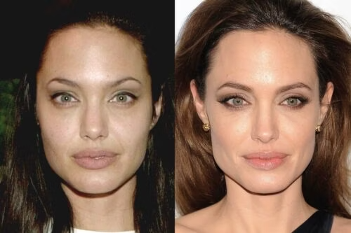 Angeline Jolie Neck and Facelift
