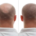 Artificial Hair Transplant