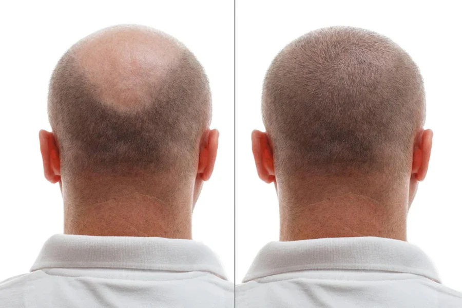 Artificial Hair Transplant