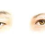 Asian Eyelid Surgery