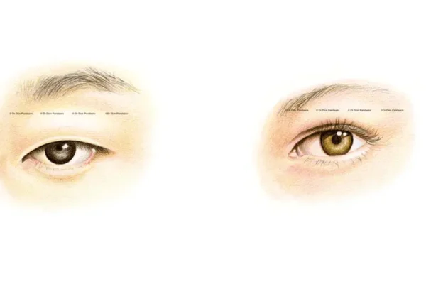 Asian Eyelid Surgery