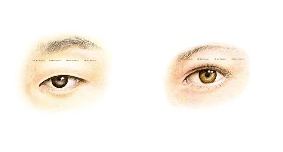 Asian Eyelid Surgery