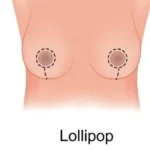 Breast Fat Removal Surgery