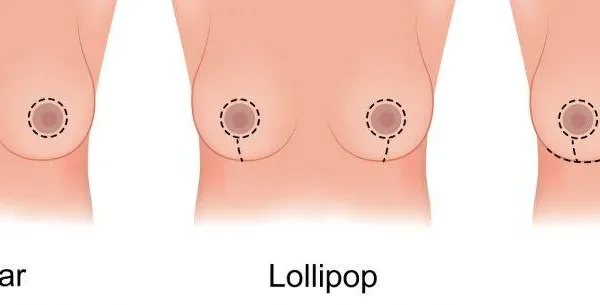 Breast Fat Removal Surgery