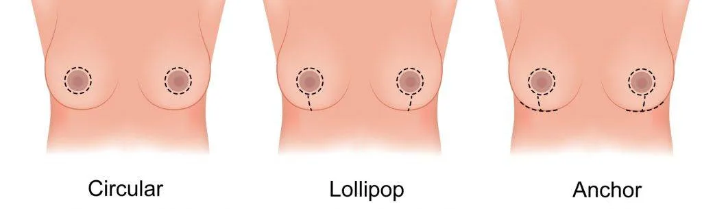 Breast Fat Removal Surgery