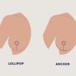 Breast Surgery Scar Types