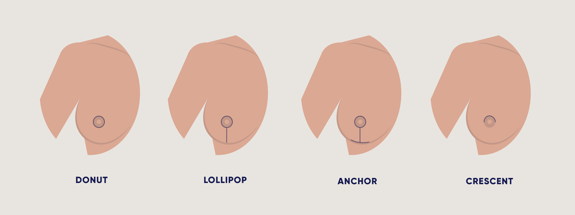 Breast Surgery Scar Types