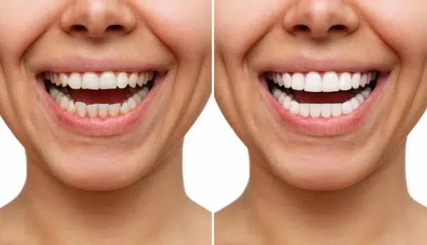 Composite Veneers
