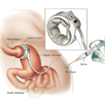 Gastric Band Adjustments