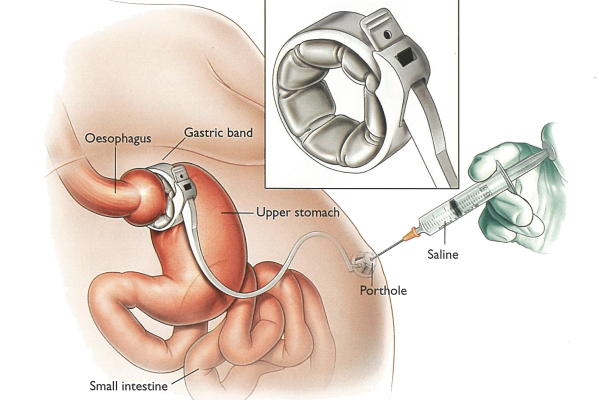 Gastric Band Adjustments