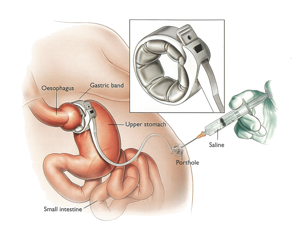 Gastric Band Adjustments