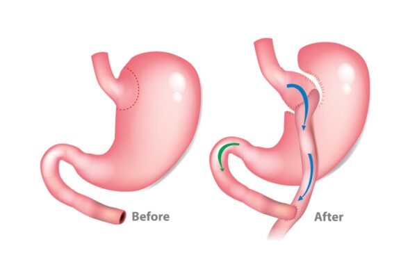 Gastric Bypass Surgery Purpose