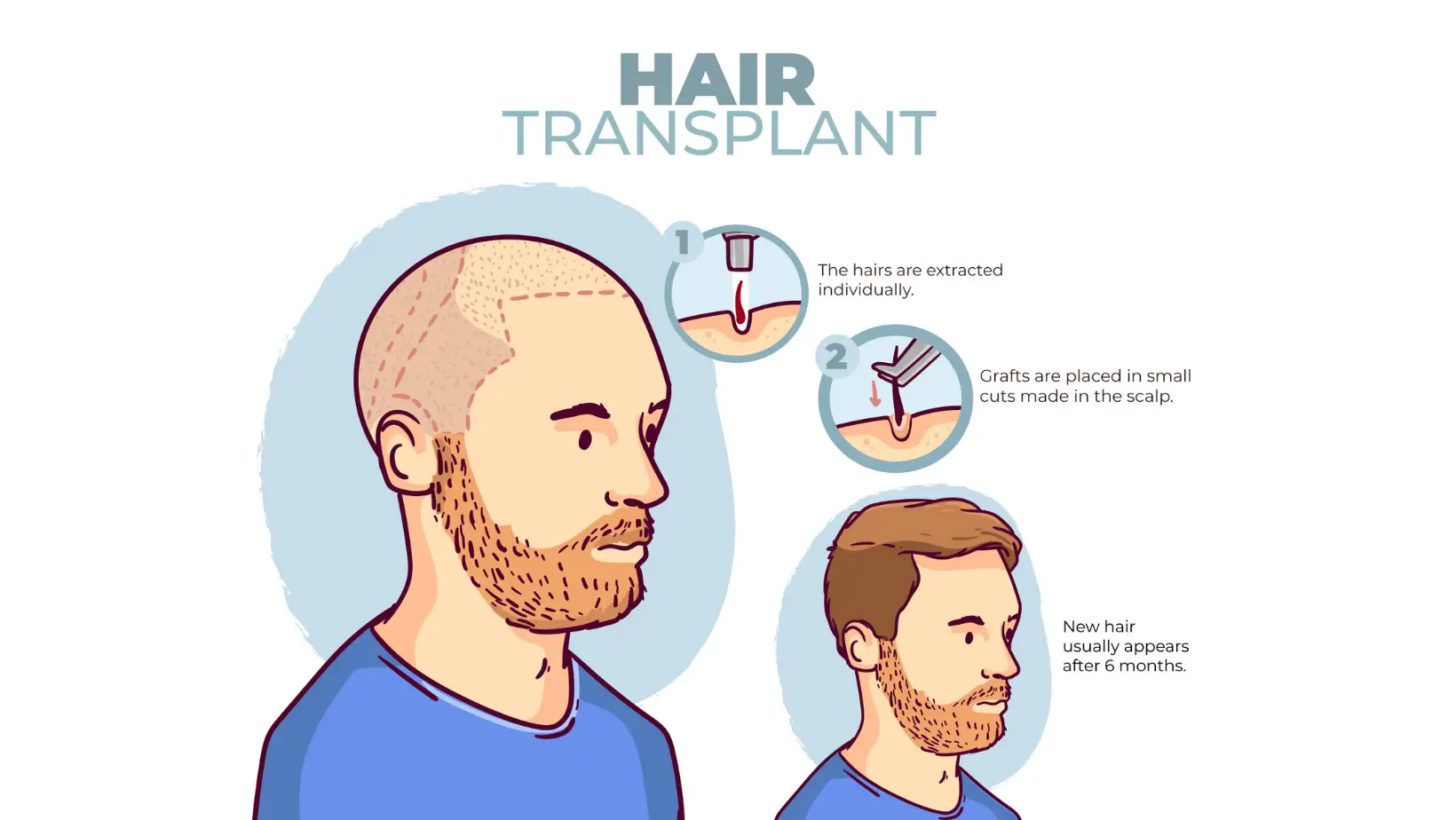 Hair Transplant Timeline