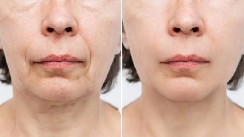 How Long Does a Facelift Last